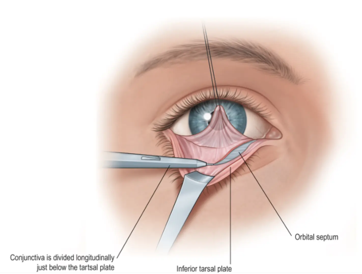 illustration of a blepharoplasty procedure
