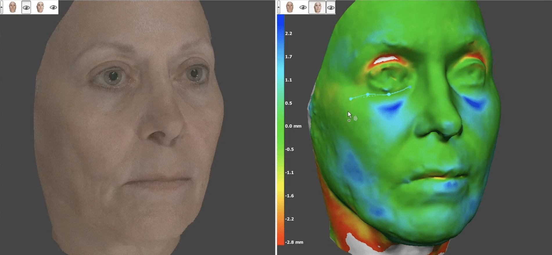 3D Facial Scanning Before Cosmetic Surgery