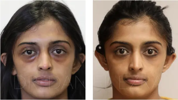 Dental prince Multiplication Before and After Eyelid Treatment by a UK Eyelid Surgeon | Daniel Ezra