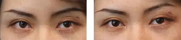 Revision blepharoplasty before and after