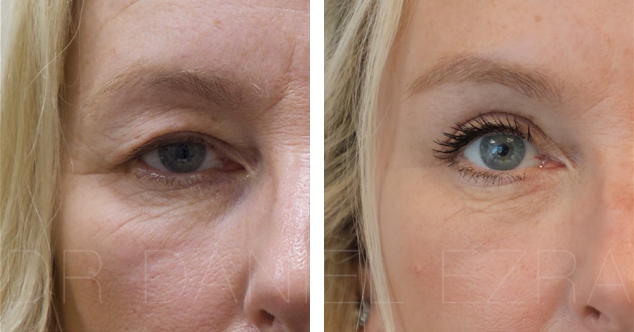 Blepharoplasty plus before and after