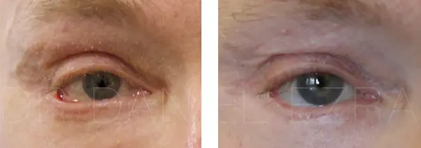 Blepharoplasty revision before and after