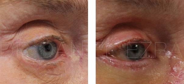 Revision blepharoplasty before and after
