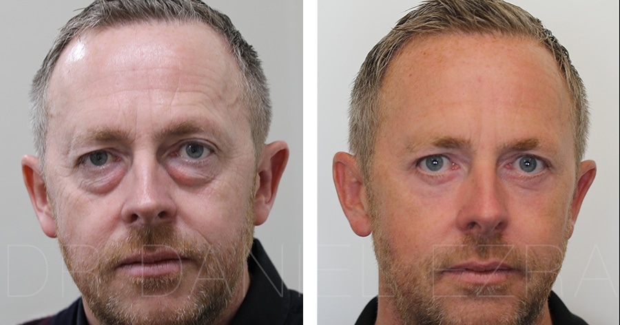 lower eyelid surgery before and after