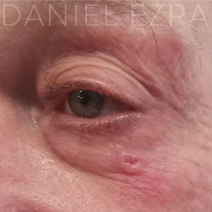 eyelid tumour example 1