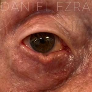 eyelid tumour example 2
