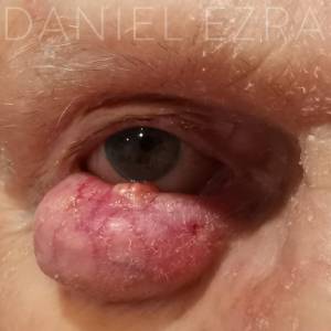 eyelid tumour example 3