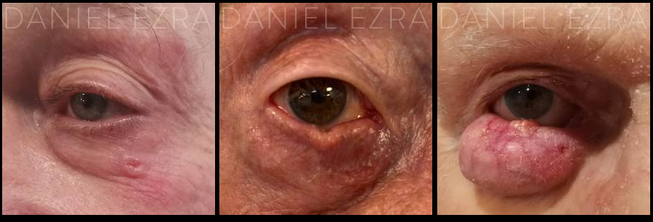 Examples of Eyelid Basal Cell Carcinoma