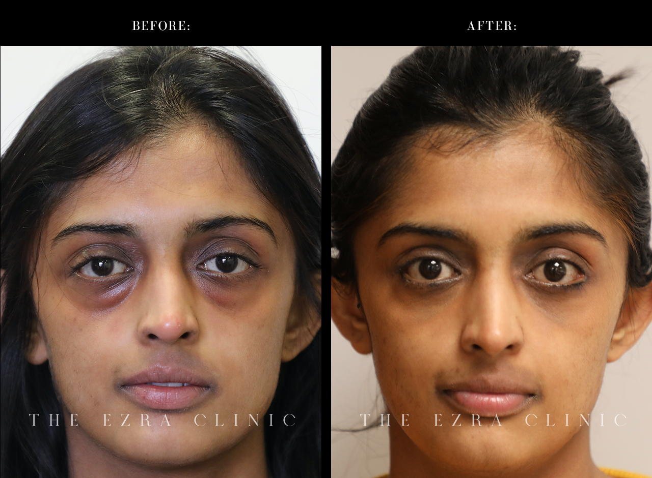 blepharoplasty before and after portrait