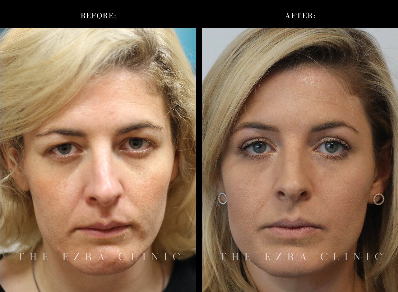 blepharoplasty plus before and after