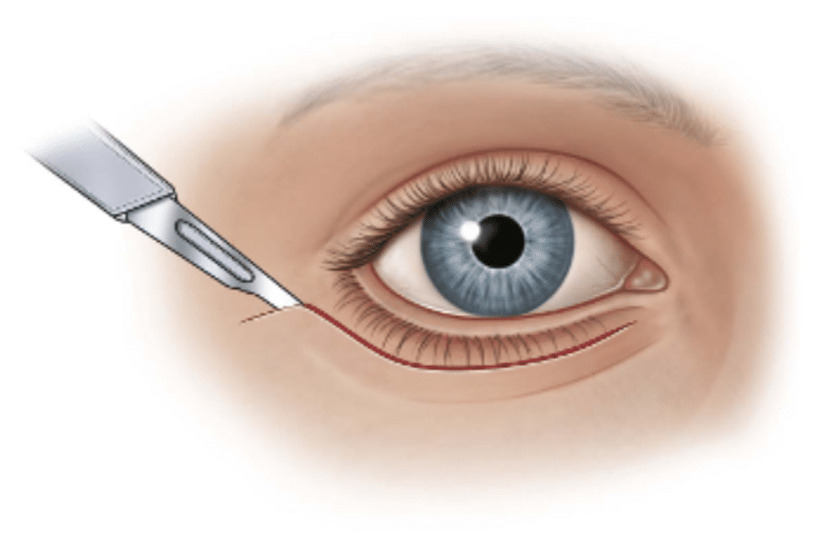 blepharoplasty surgical incision illustration
