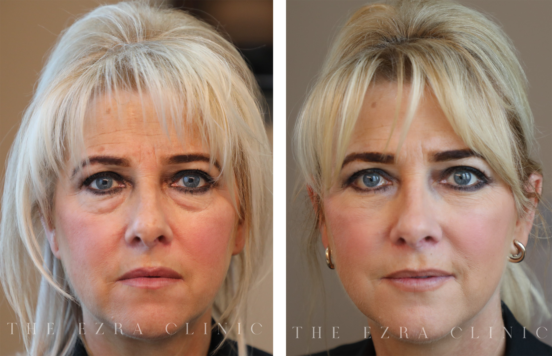 Before and After Eyelid Treatment by a UK Eyelid Surgeon