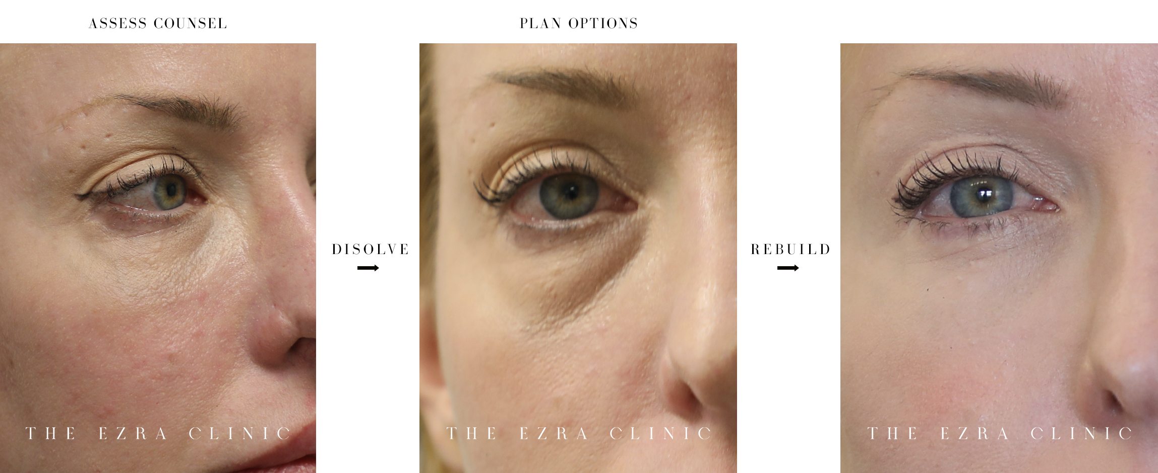 process of filler dissolving on a woman's eye area. It shows the before and after in three steps: assess counsel, disolve and rebuild. 