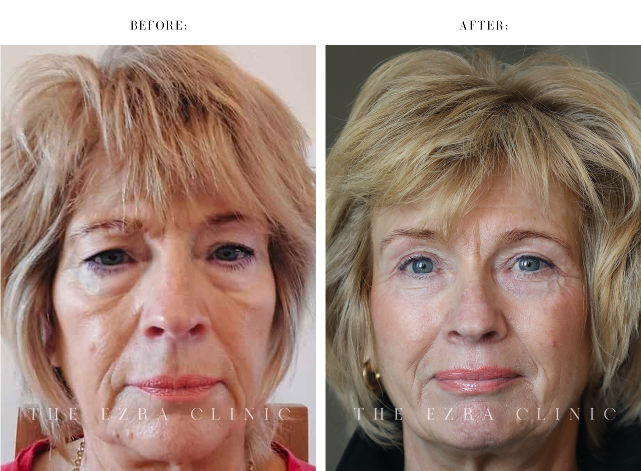 white woman lower blepharoplasty before and after