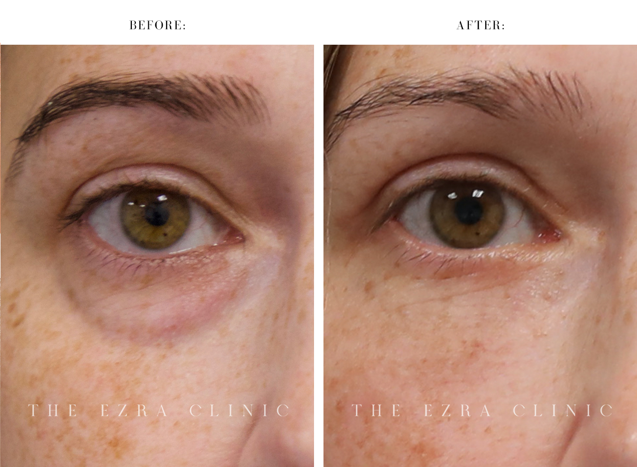 woman with hazel eyes before and after blepharoplasty