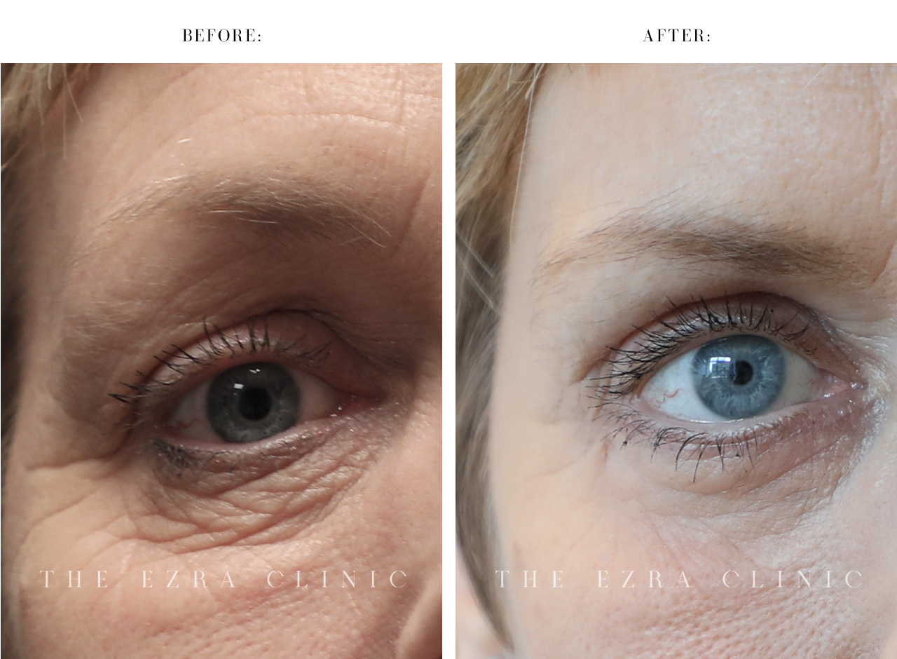 white woman before and after upper and lower eyelid blepharoplasty