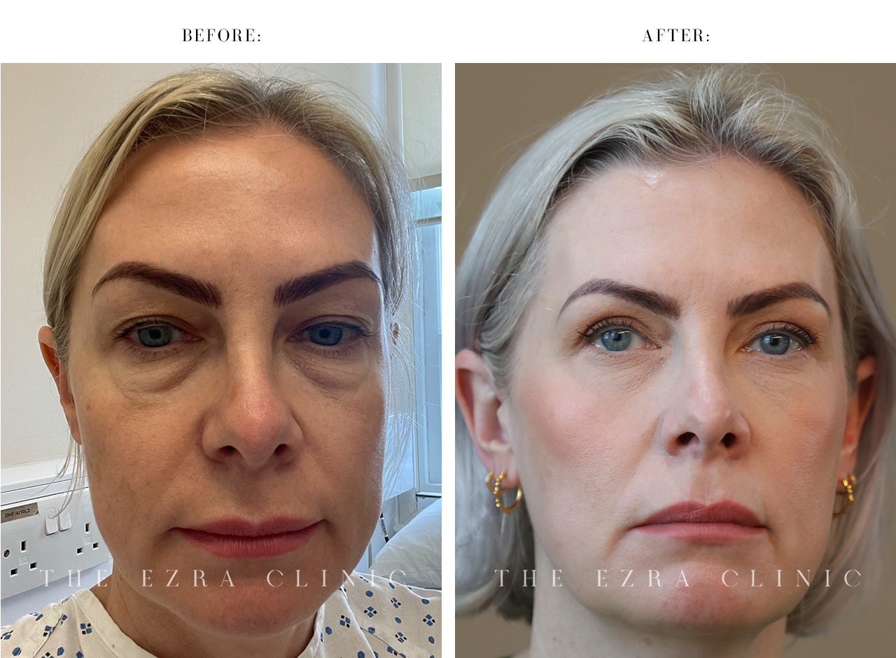 white woman before and after blepharoplasty plus