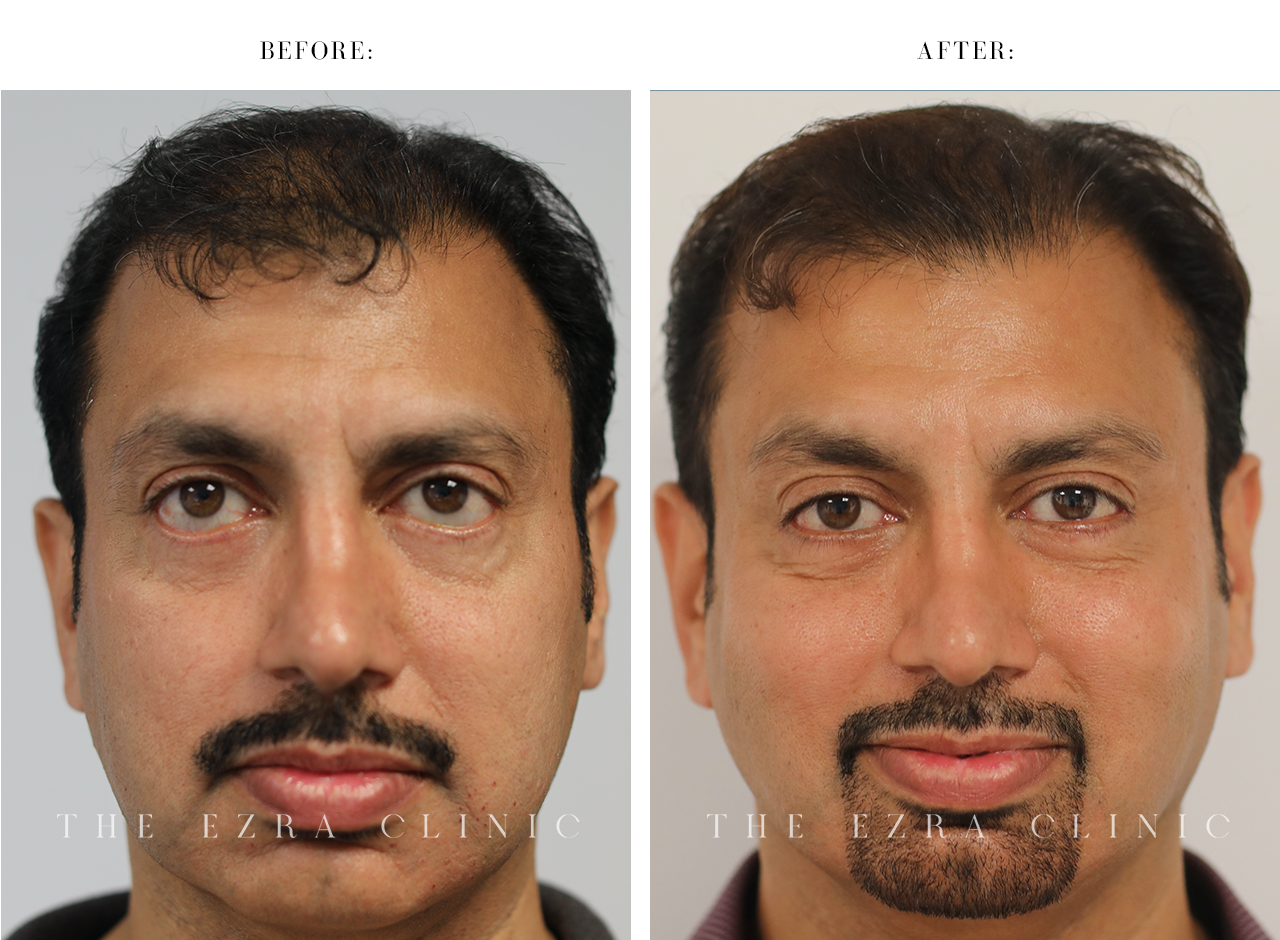 man before and after revision blepharoplasty