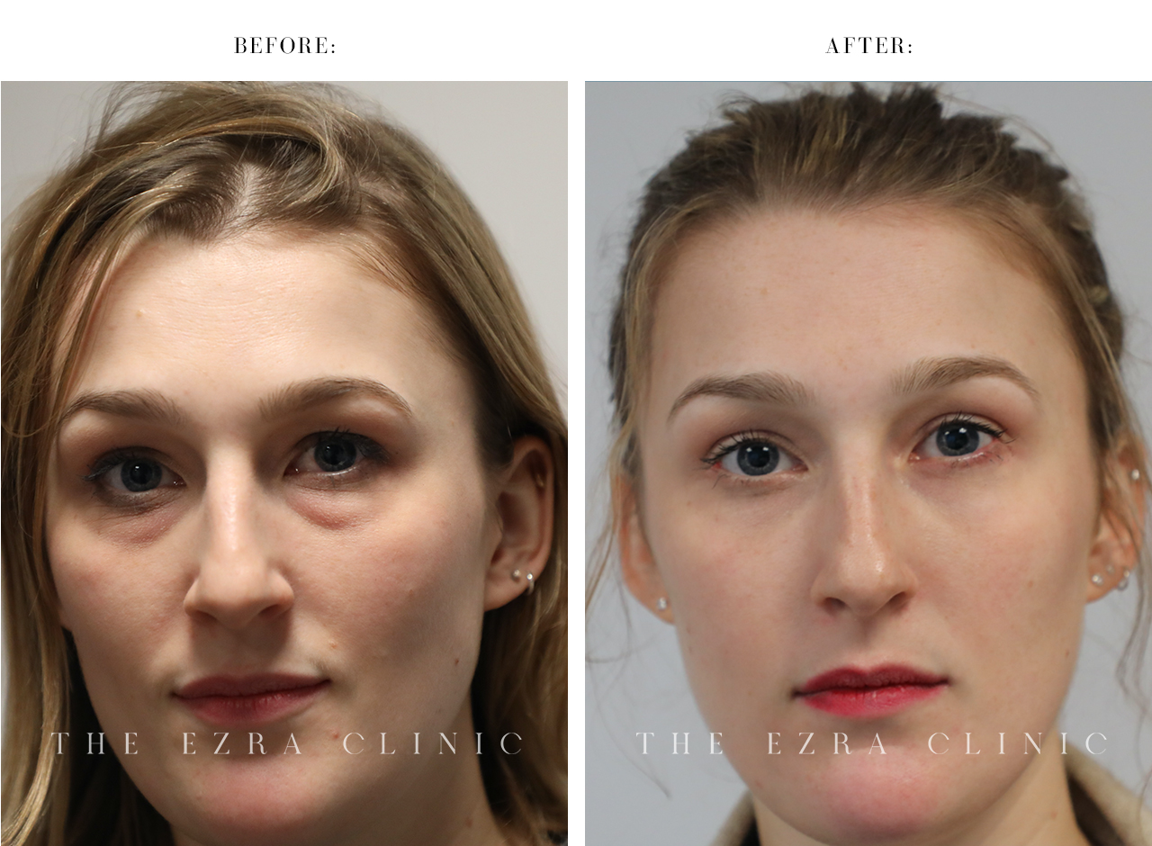 White woman before and after lower lid transconjunctival blepharoplasty