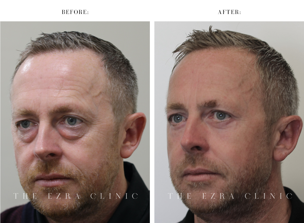 white man before and after blepharoplasty plus