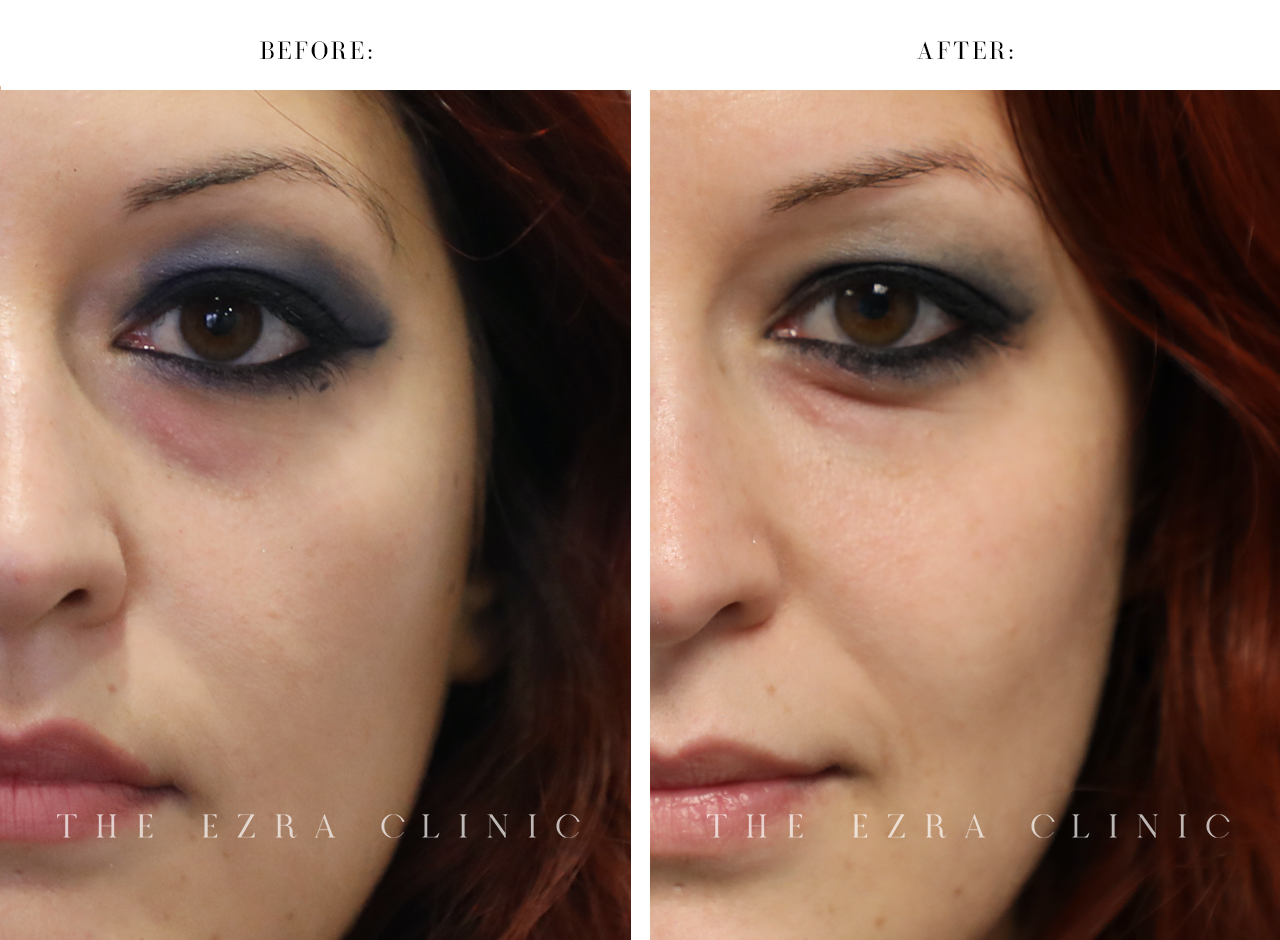 before and after of dermal filler injections on the cheek and tear trough