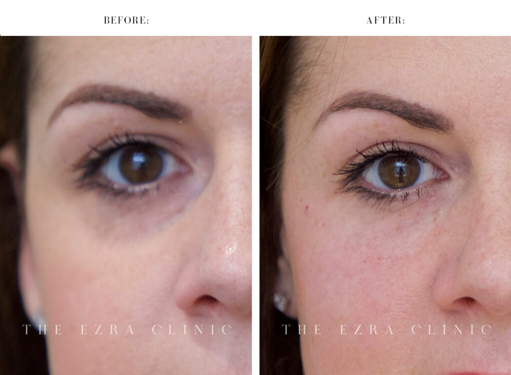 Before and after of dermal filler treatment in the eye area and cheeks