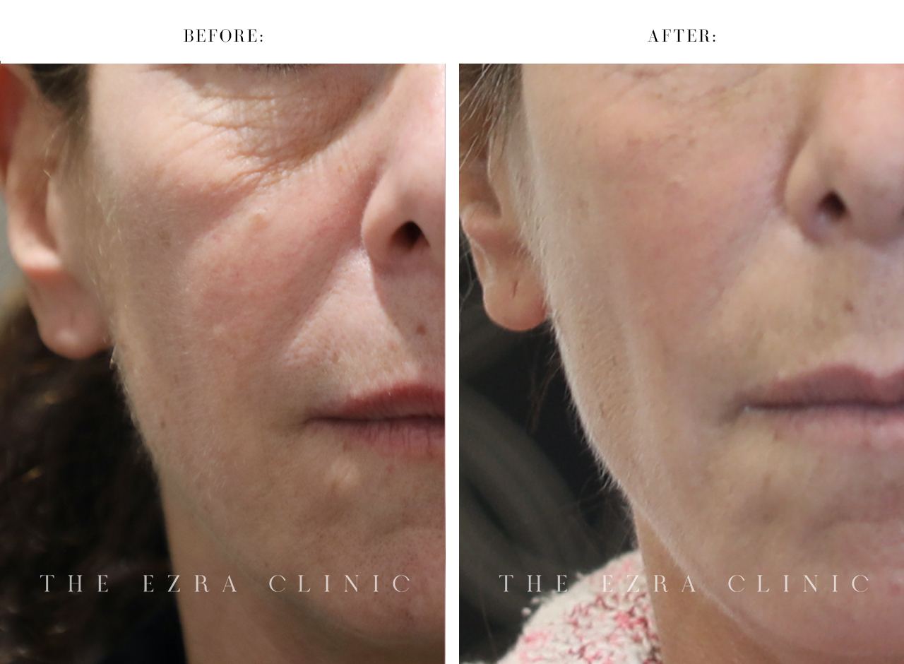 Before and after of dermal filler treatment on woman patient