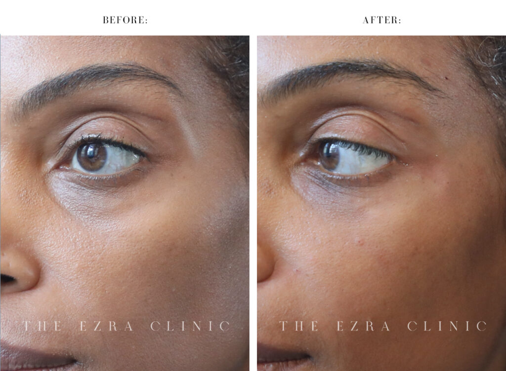 dermal filler before and after of lower eye area
