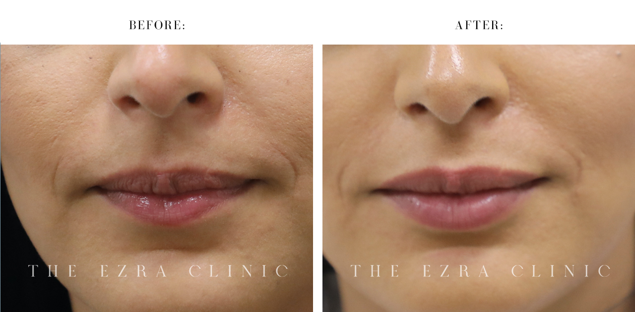 before and after of dermal filler on the lips