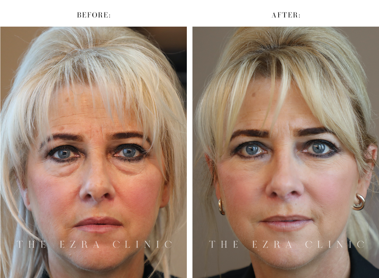 white woman before and after Blepharoplasty Plus with Midface Lift