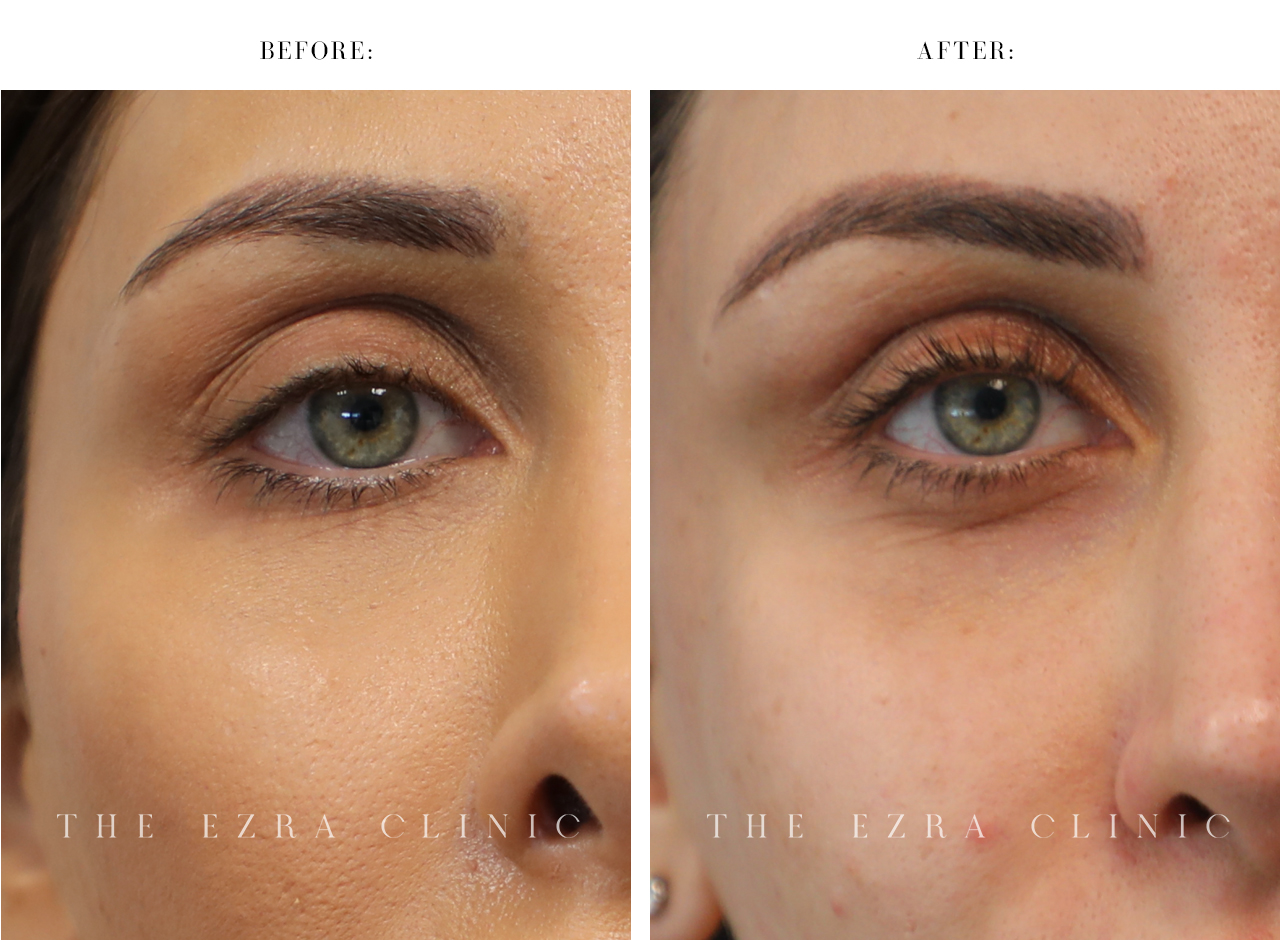 Before and after image of filler dissolving procedure