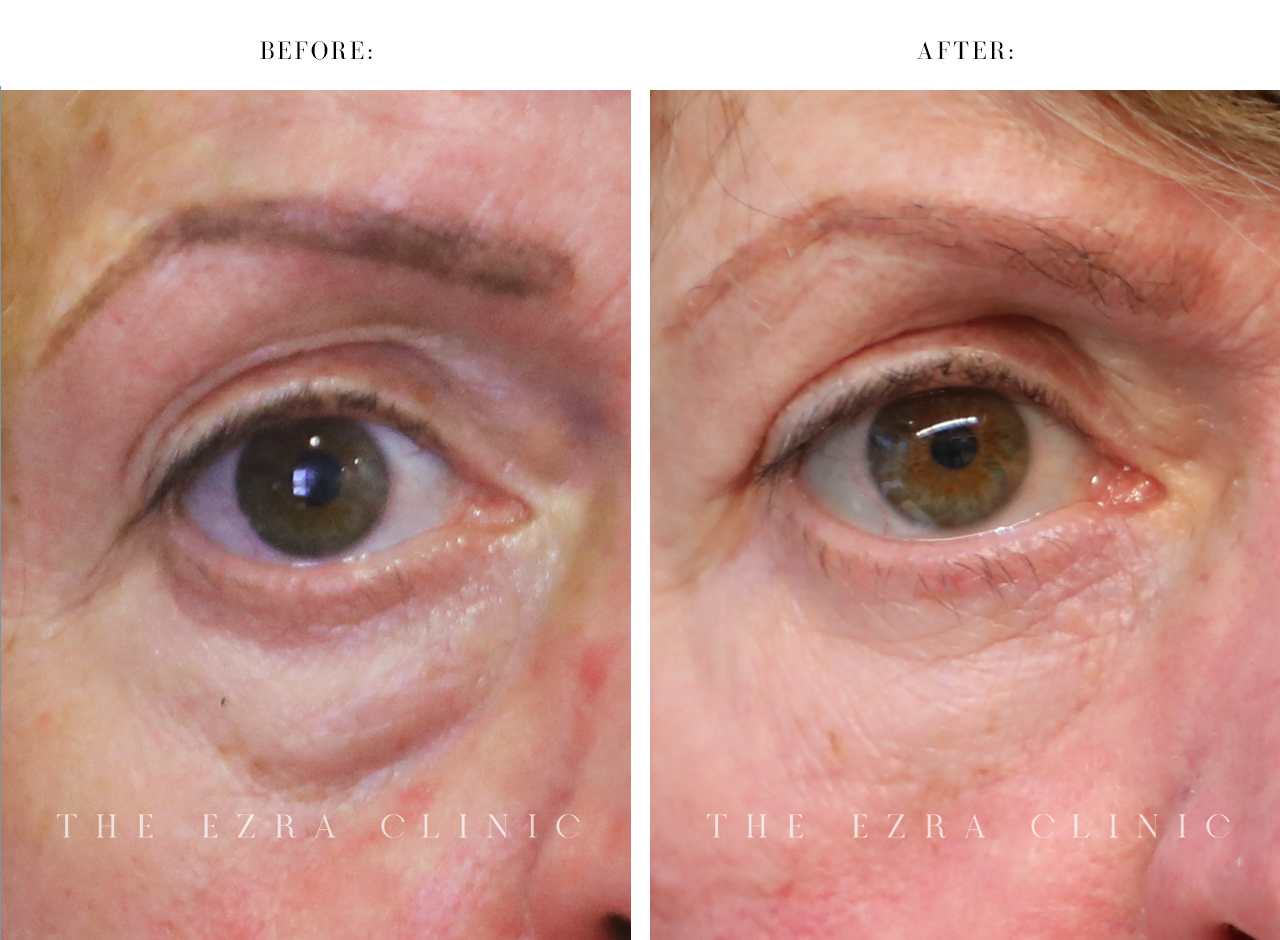 white woman before and after blepharoplasty plus