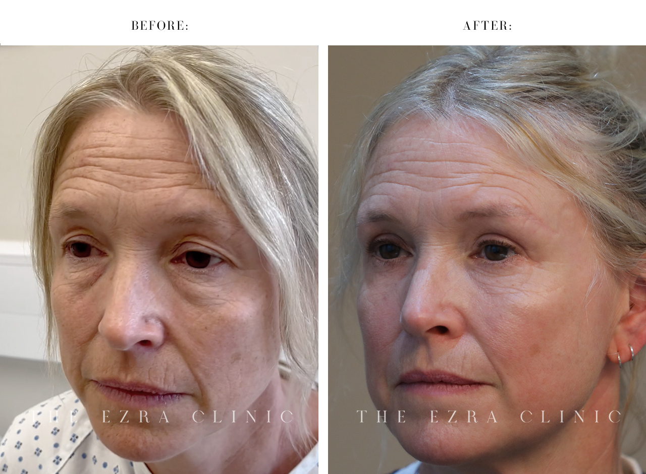 BLEPHAROPLASTY PLUS WITH DIRECT BROW LIFT