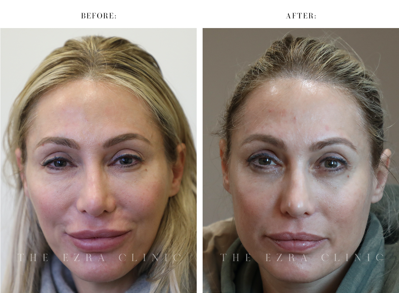 image of woman in a cosmetic procedure. Specialist is managing an injectable on her lips