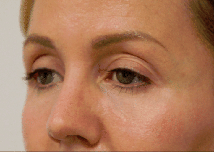 After Tear Trough Fillers (side view)