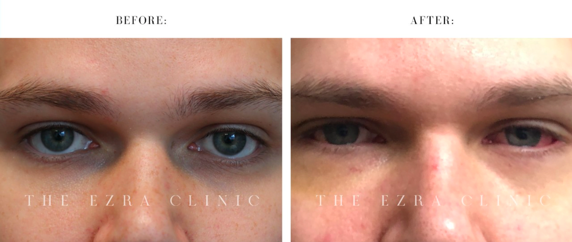 almond eye surgery before and after