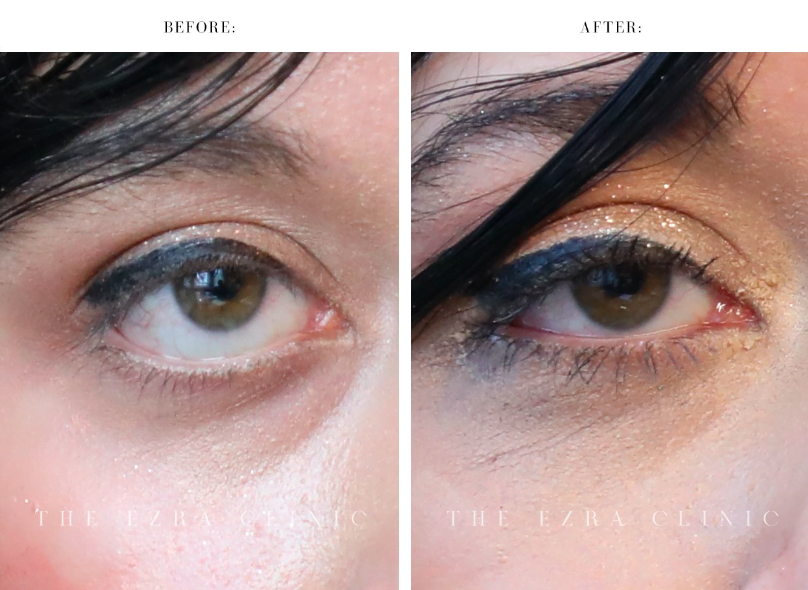 almond eye surgery before and after