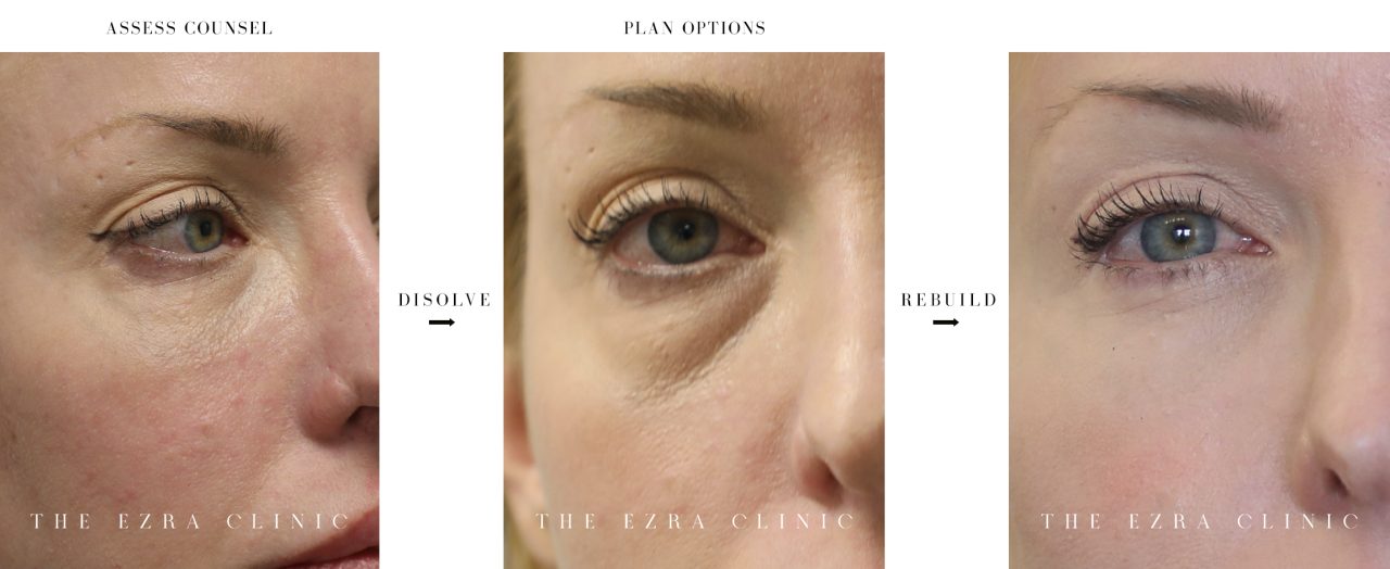 process of filler dissolving on a woman's eye area. It shows the before and after in three steps: assess counsel, disolve and rebuild.