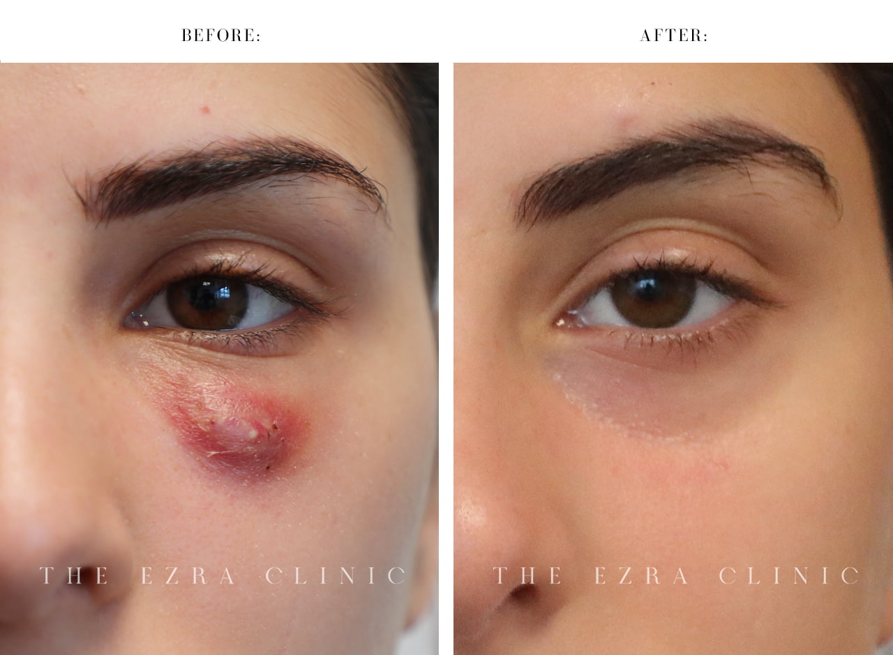 Woman with complications from a filler in the before image and with healed skin after filler dissolving