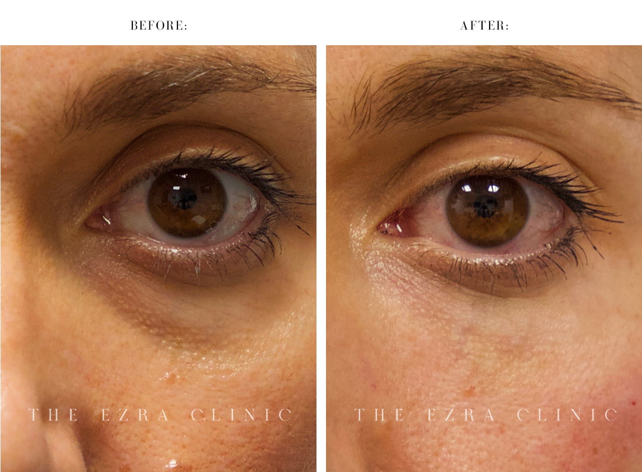woman Tear Trough Fillers Before and After