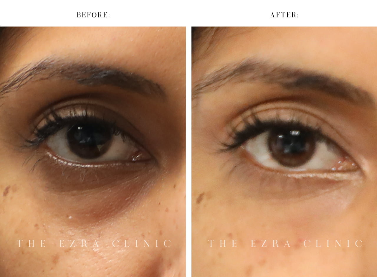 Woman before and after tear through fillers