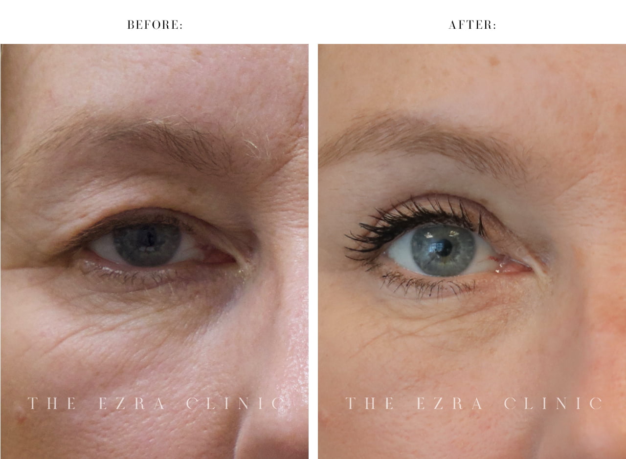 Blepharoplasty London Eyelid Surgery Oculoplastic Surgeon