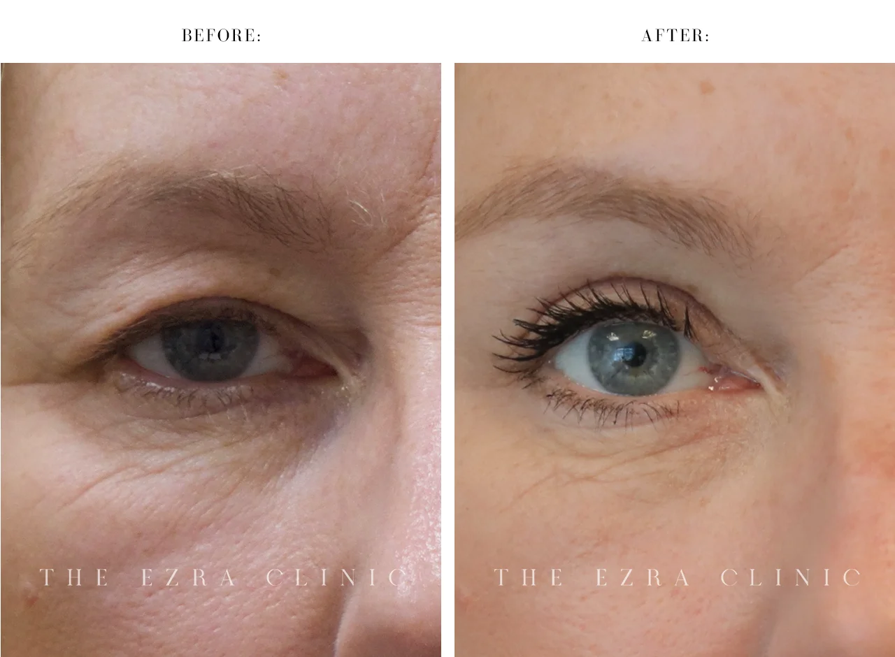 white woman before and after upper lid blepharoplasty