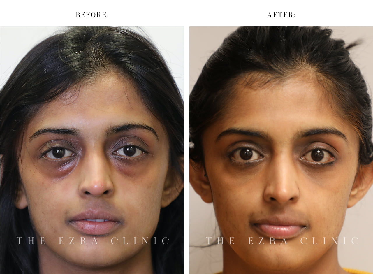 Lower eyelid surgery cost discount