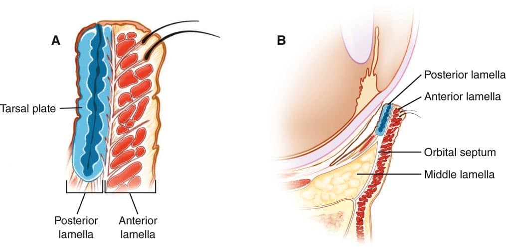Lower Lid Almond Eye Surgery