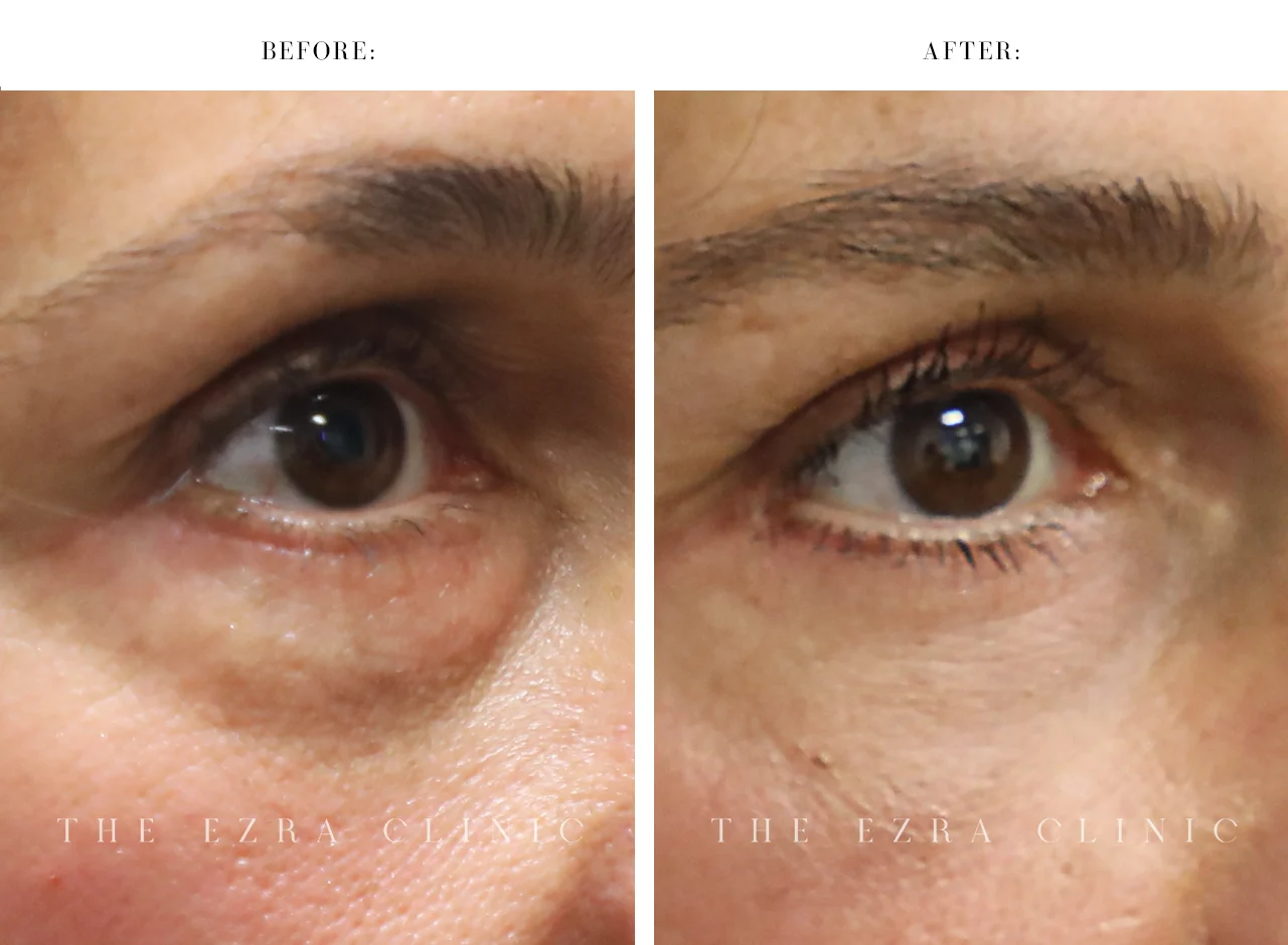 White woman before and after lower lid blepharoplasty