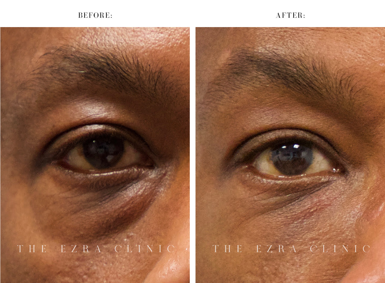 man before and after tear trough filler