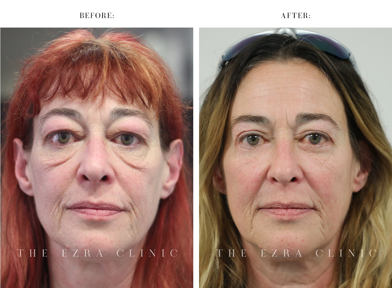 White woman before and after upper and lower blepharoplasty