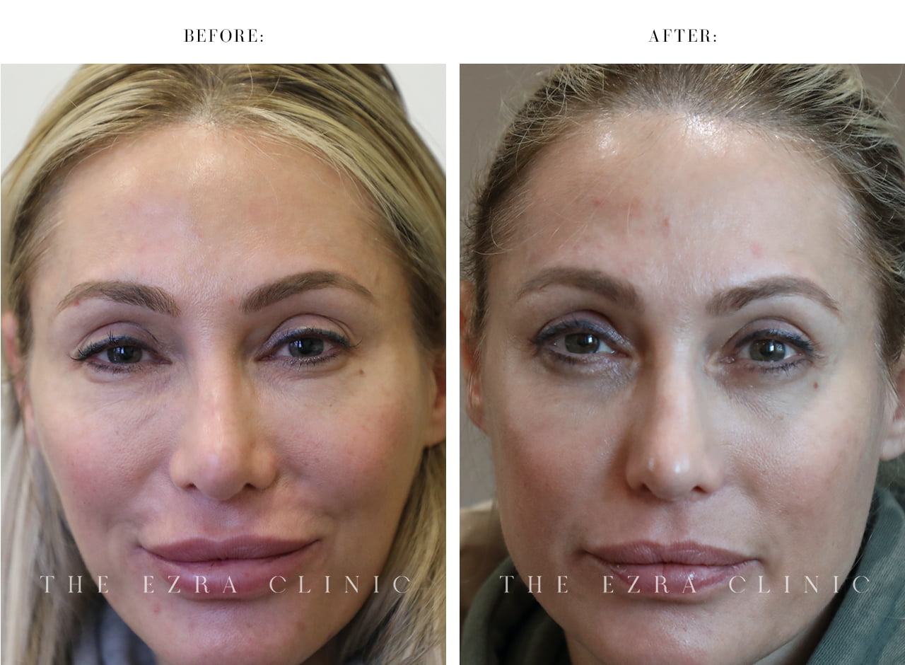 woman face before and after dissolving facial fillers