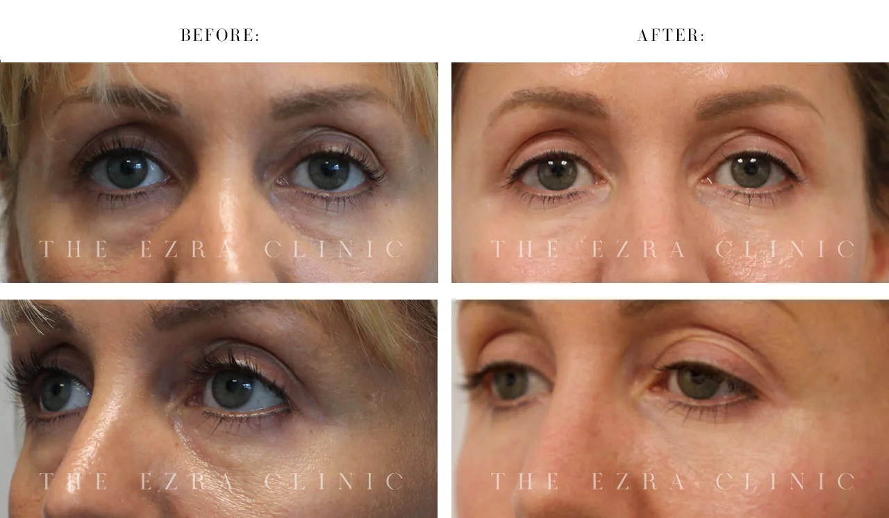 Tear Trough Filler Before and After